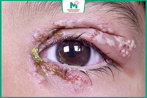 triệu chứng mụn rộp ở mắt