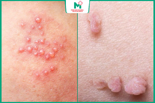 các loại mụn sinh dục nam