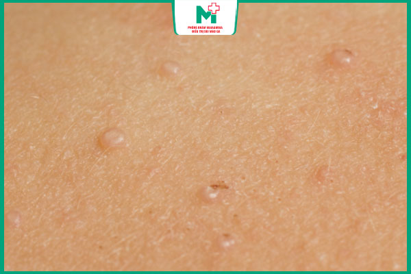 đặc điểm mụn cóc phẳng