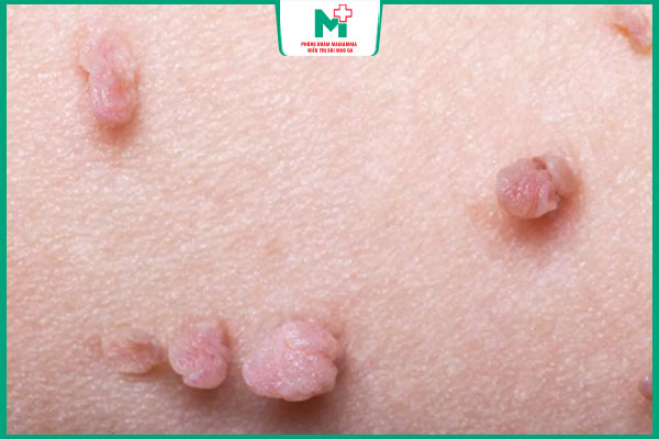 đặc điểm mụn sinh dục