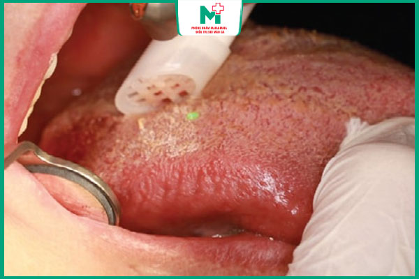 đốt mụn cóc ở lưỡi