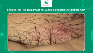hình ảnh nổi mụn ở vùng kín