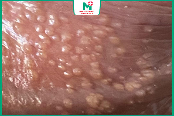 mức độ nguy hiểm mụn trắng bao quy đầu