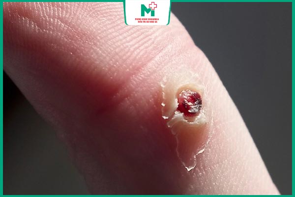 mụn cóc chảy máu
