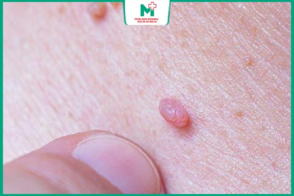 mụn cóc dạng mảnh