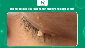mụn cóc dạng sợi