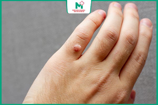 mụn cóc mọc ở ngón tay