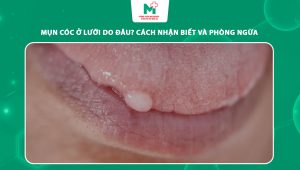 mụn cóc ở lưỡi