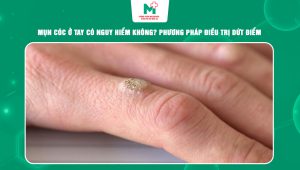 mụn cóc ở tay