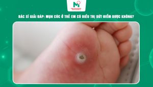 mụn cóc ở trẻ em