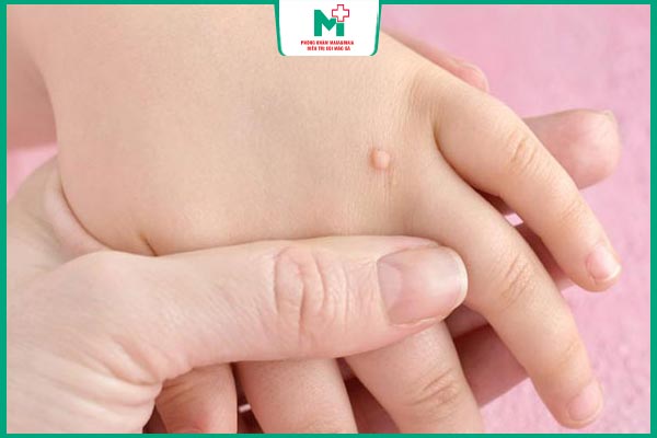mụn cóc ở trẻ nhỏ