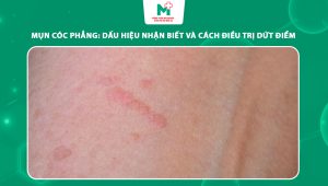 mụn cóc phẳng