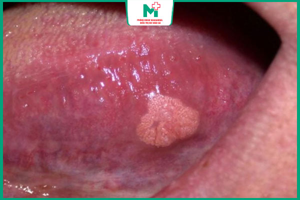 mụn cóc phát triển ở lưỡi
