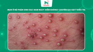 mụn ở bộ phận sinh dục nam