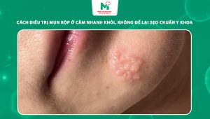 mụn rộp ở cằm