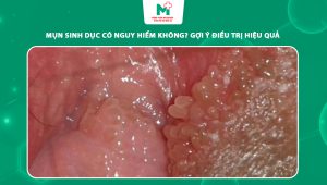 mụn sinh dục
