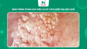 mụn trắng ở bao quy đầu