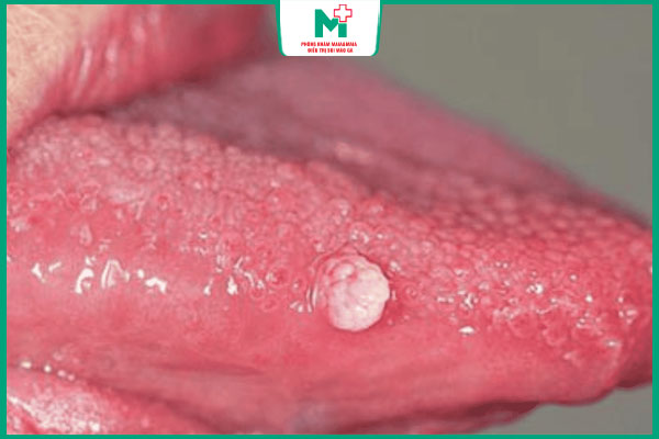 nổi mụn cóc ở lưỡi