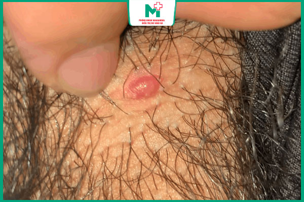 nổi mụn ở vùng kín