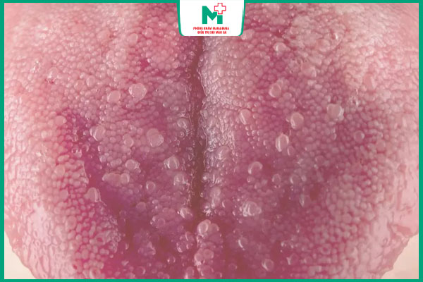 nốt mụn cóc ở lưỡi lan rộng