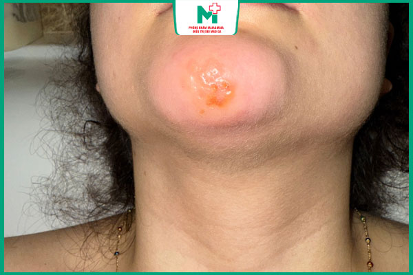 nốt mụn rộp ở cằm