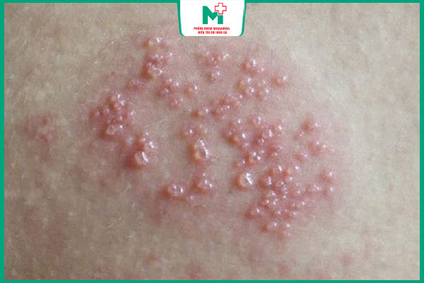 nốt mụn rộp